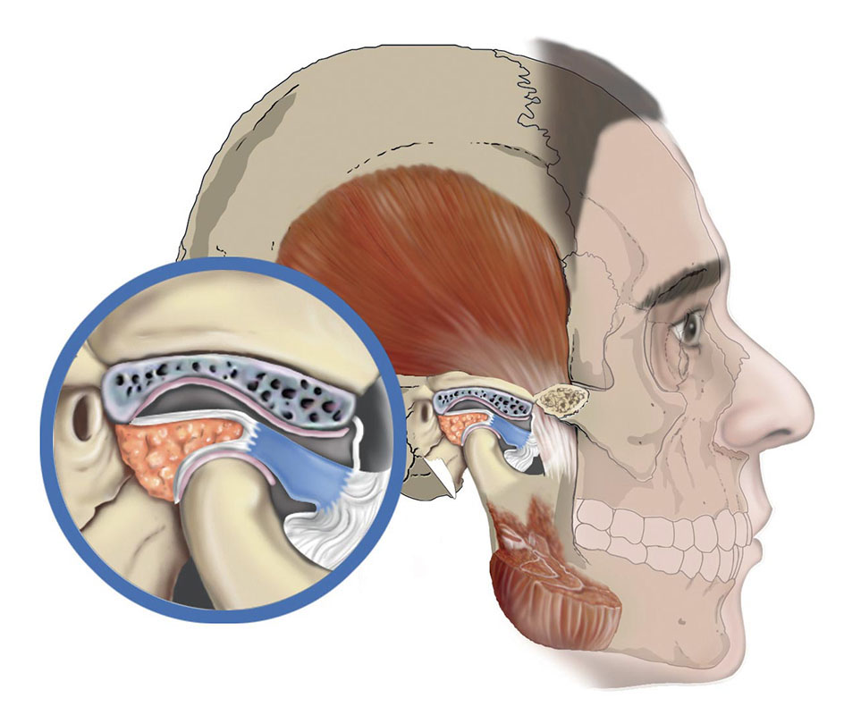 Articolazione Temporomandibolare