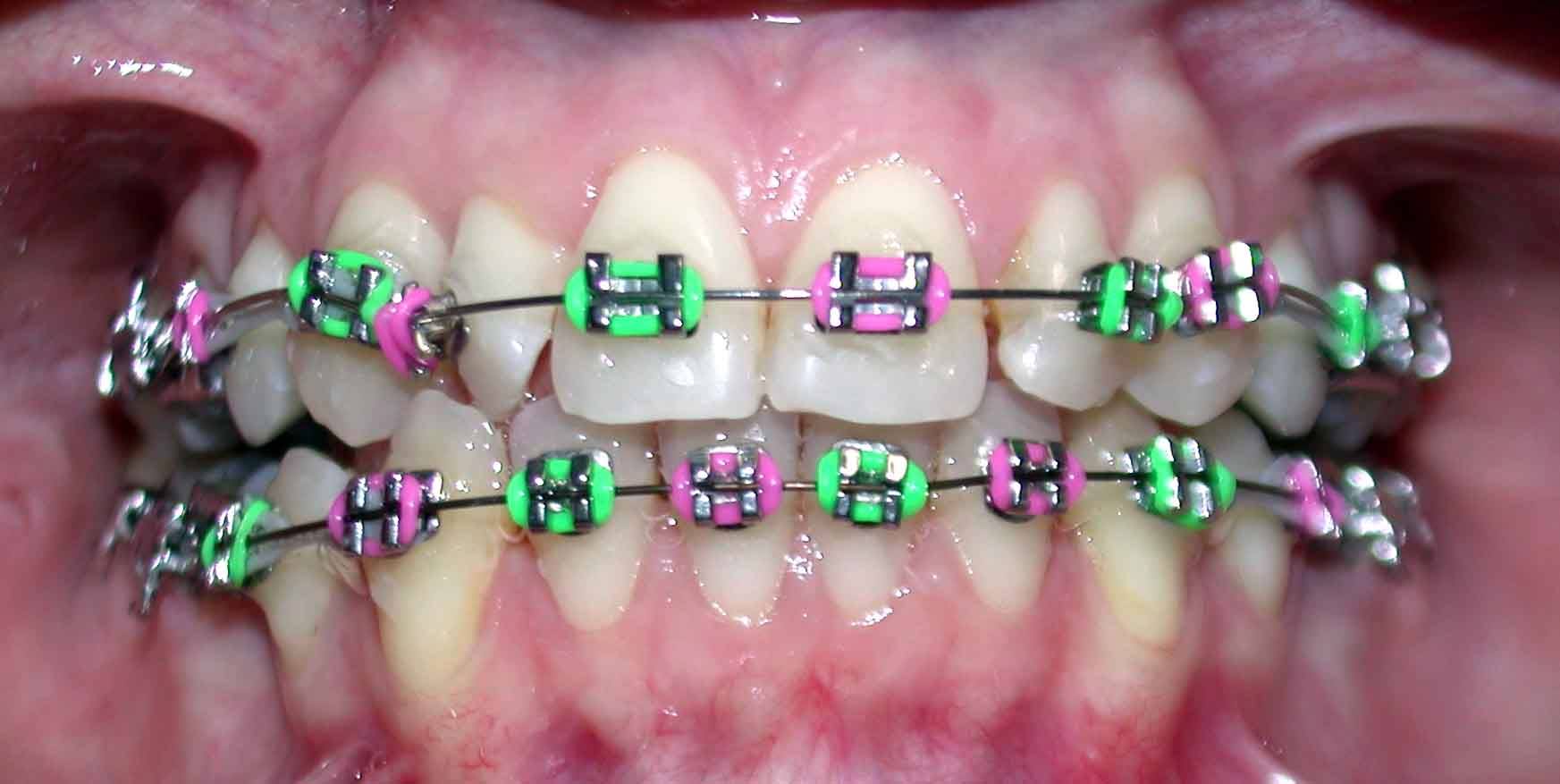 brackets