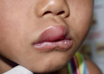 Angioedema. ? Depositphotos