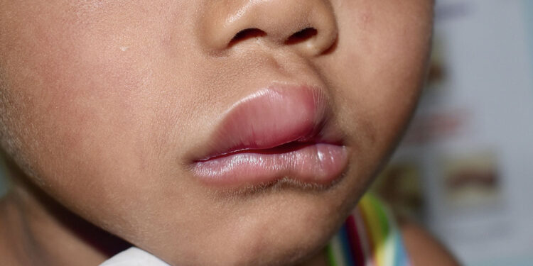 Angioedema. ? Depositphotos