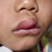 Angioedema. ? Depositphotos