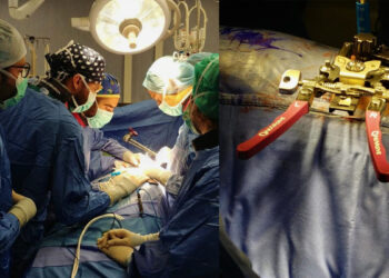 Neurochirurgia di Sassari - Tecnica XLIF cura mal di schiena cronico