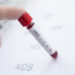 HIV AIDS test screening. ? Depositphotos